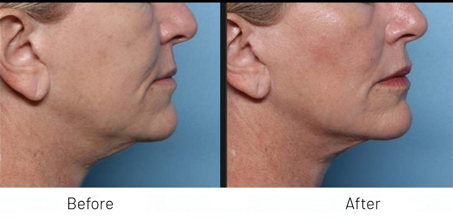 XERF FACE + NECK TOGETHER
