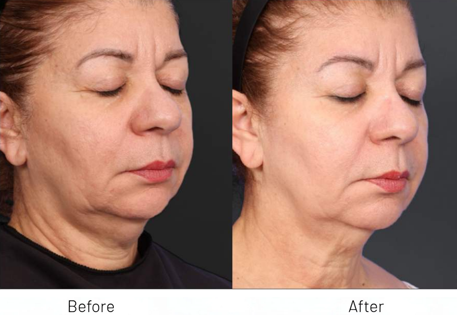 XERF FACE + NECK TOGETHER