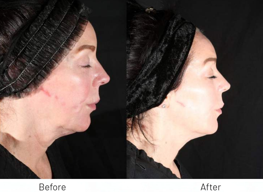 XERF FACE + NECK TOGETHER