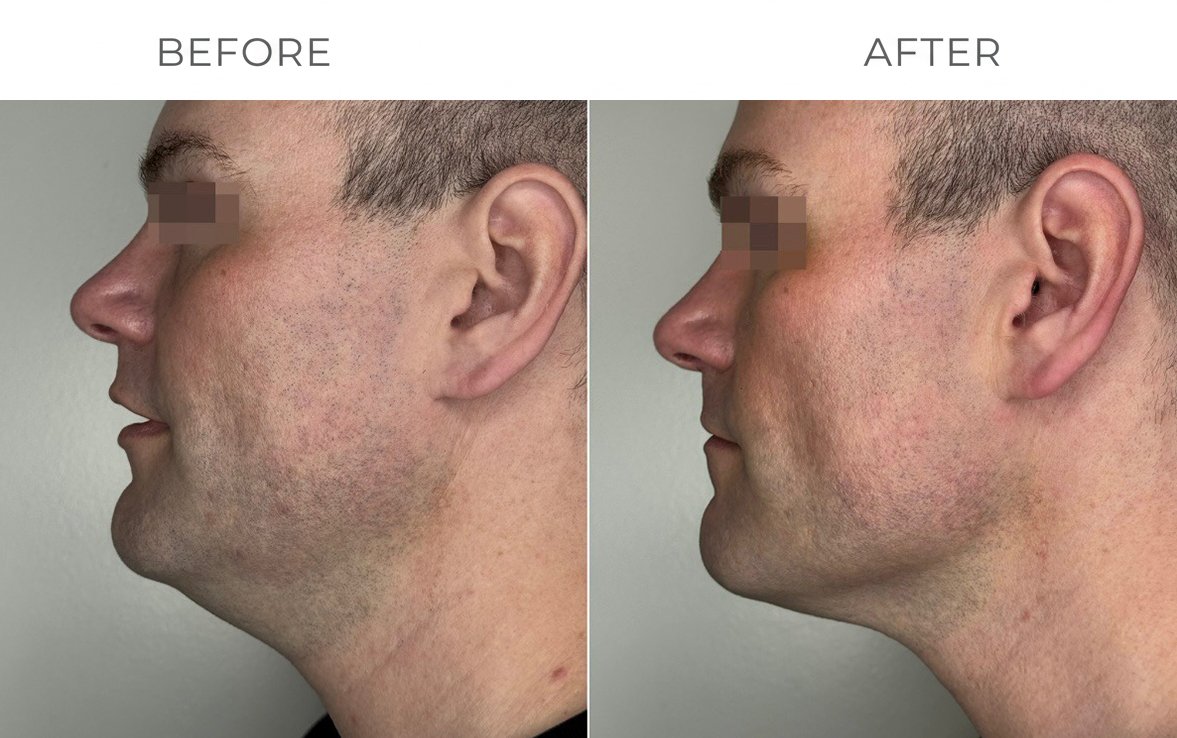 Clinical Skin Tightening Results
