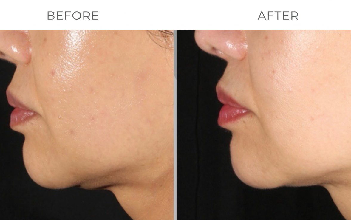 Clinical Skin Tightening Results
