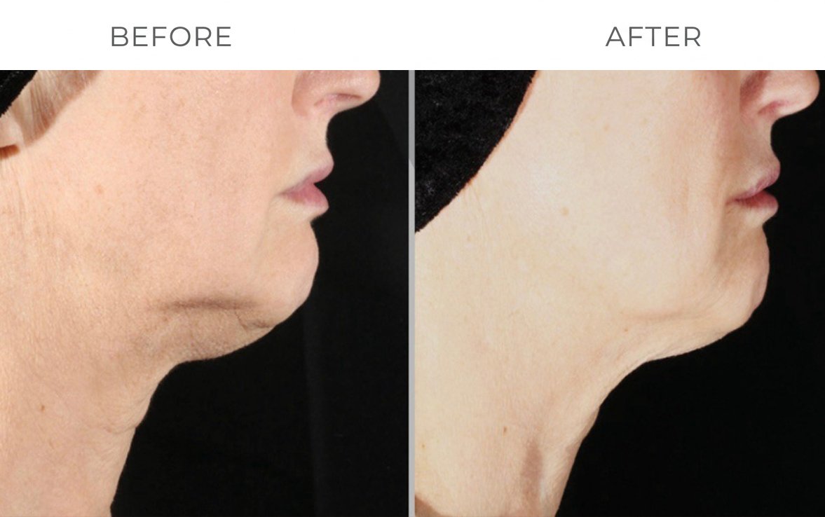Clinical Skin Tightening Results