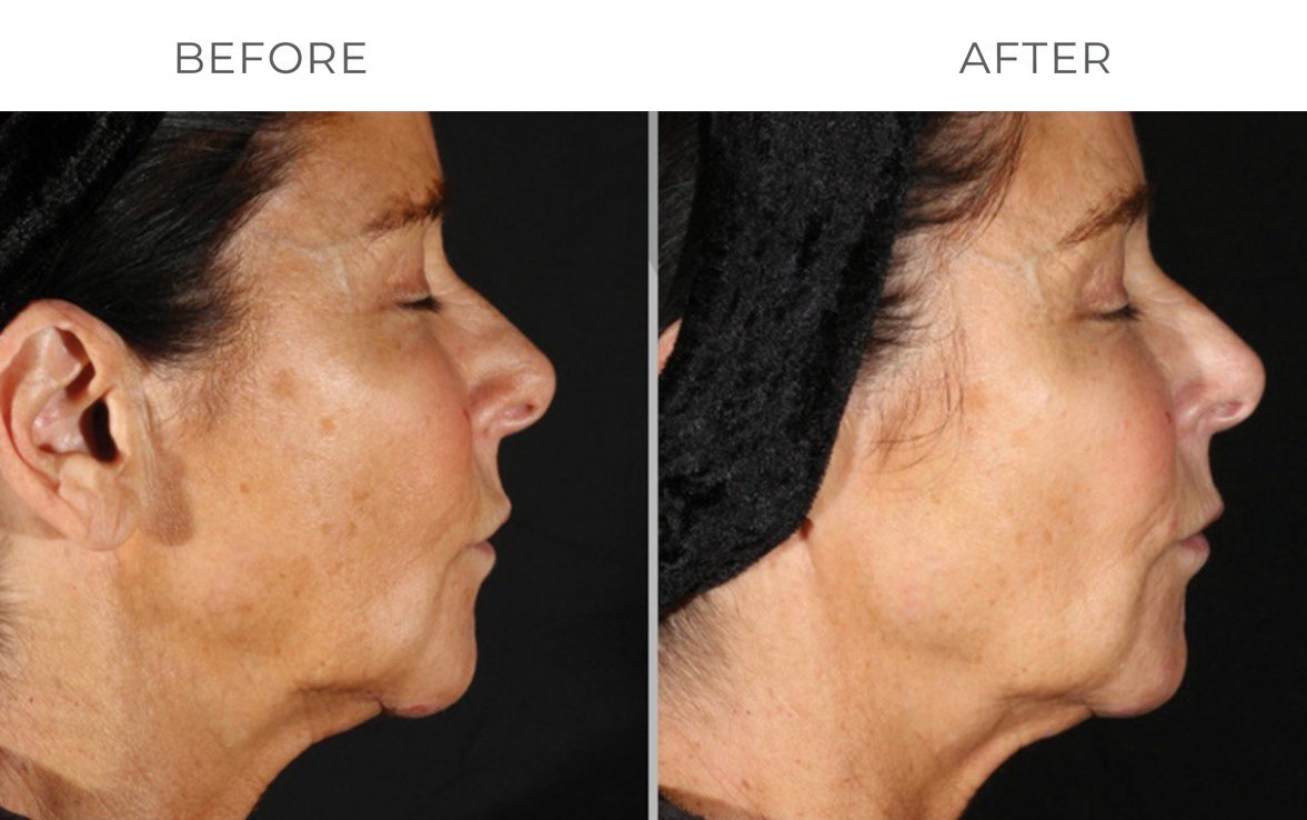 Clinical Skin Tightening Results