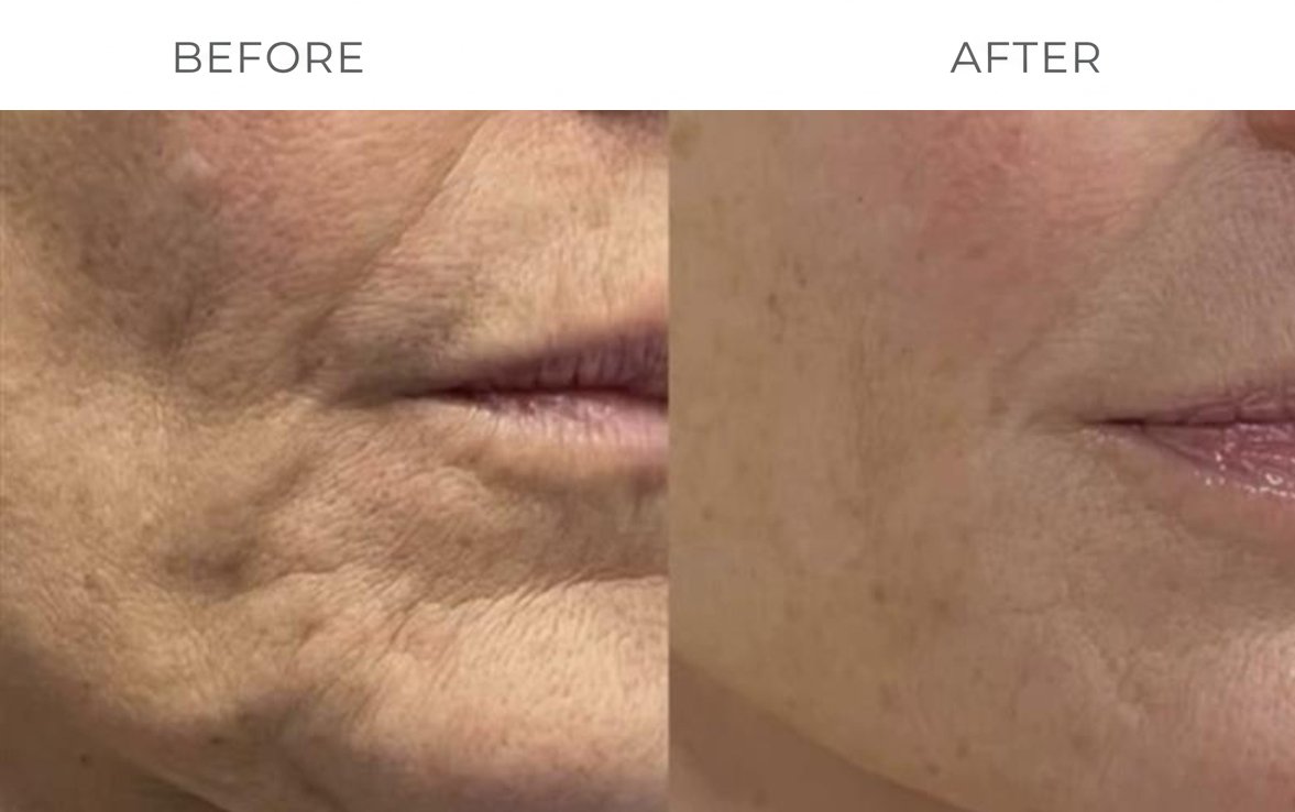Clinical Skin Tightening Results