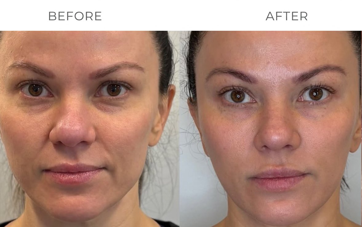 XERF skin tightening before result