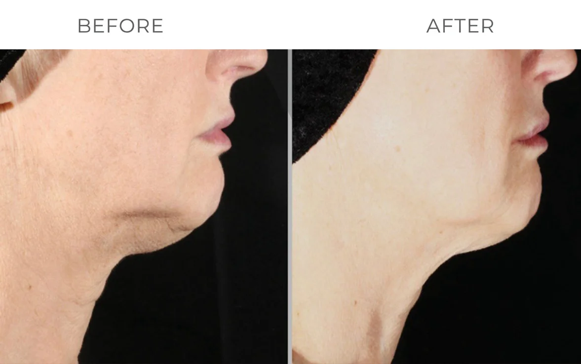 XERF skin tightening before result