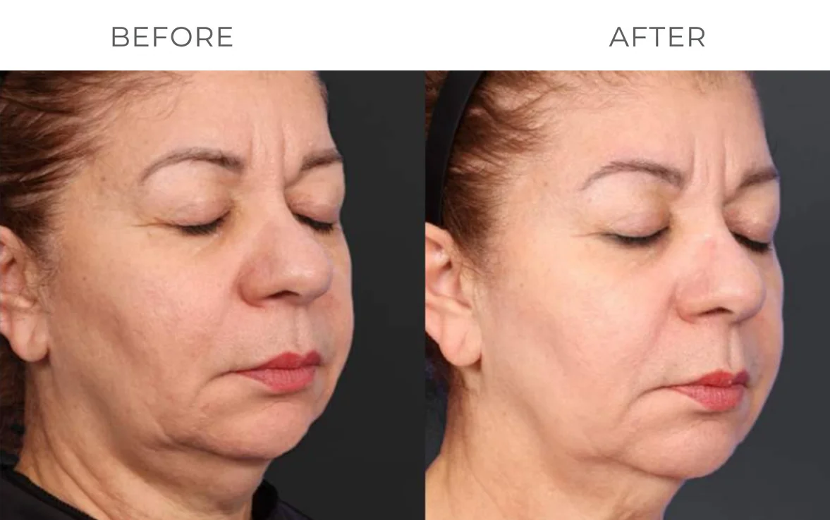 XERF skin tightening before result