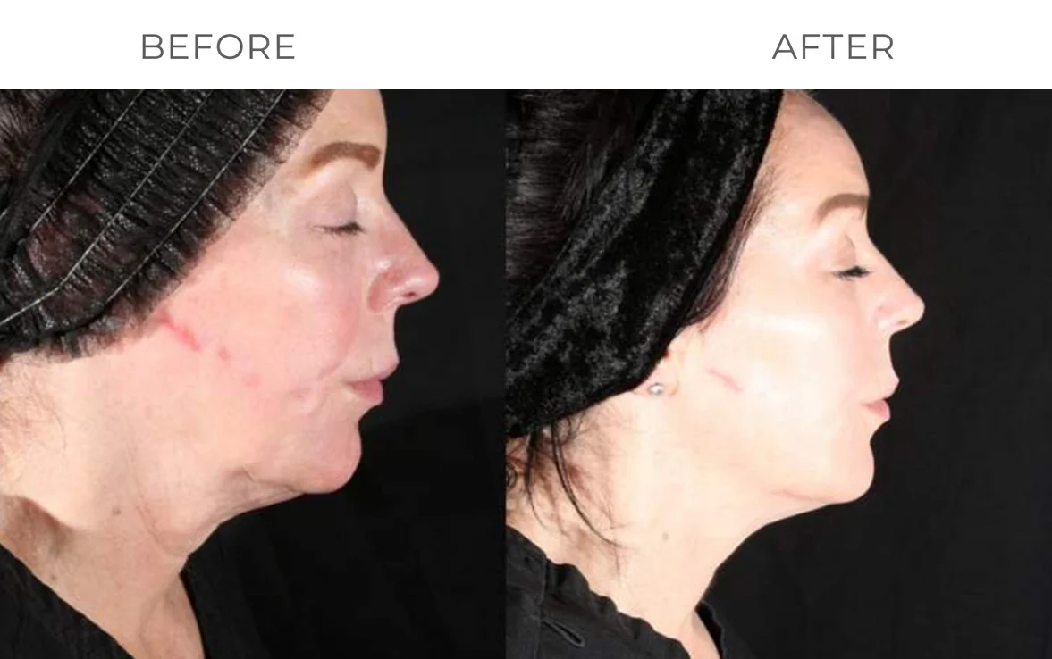 XERF skin tightening before result