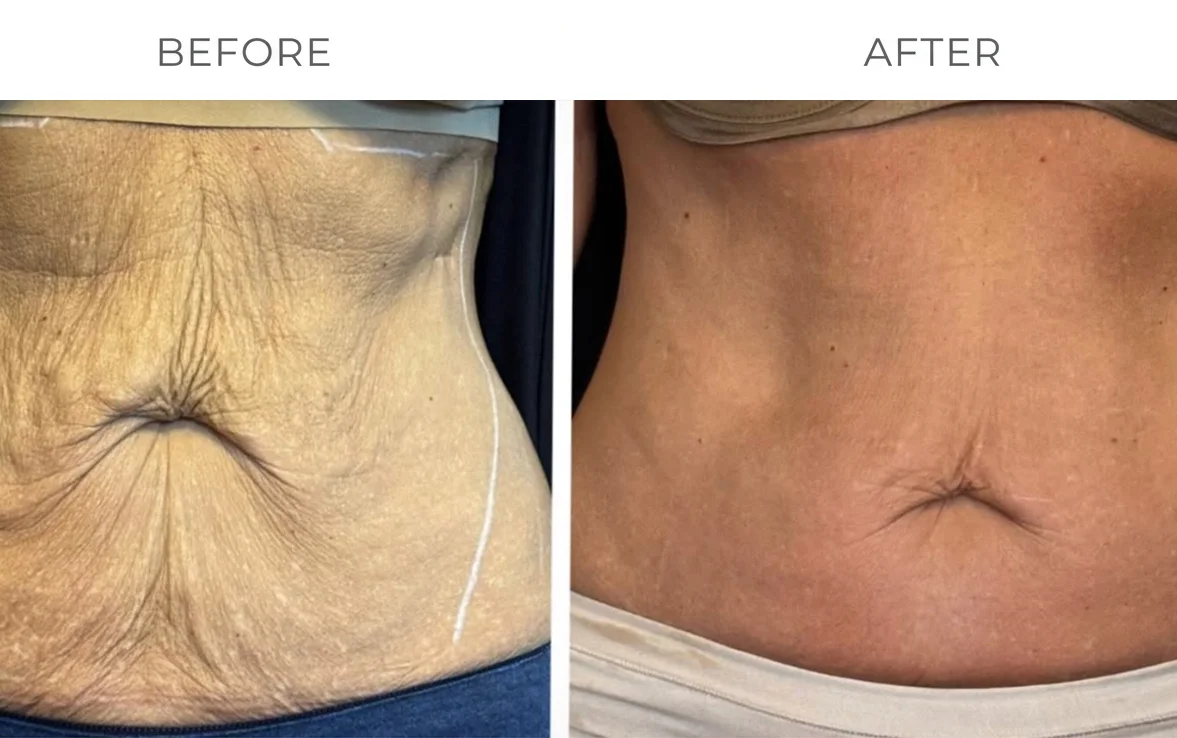 XERF skin tightening before result