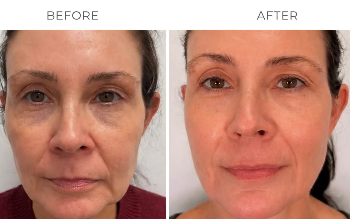 XERF skin tightening before result